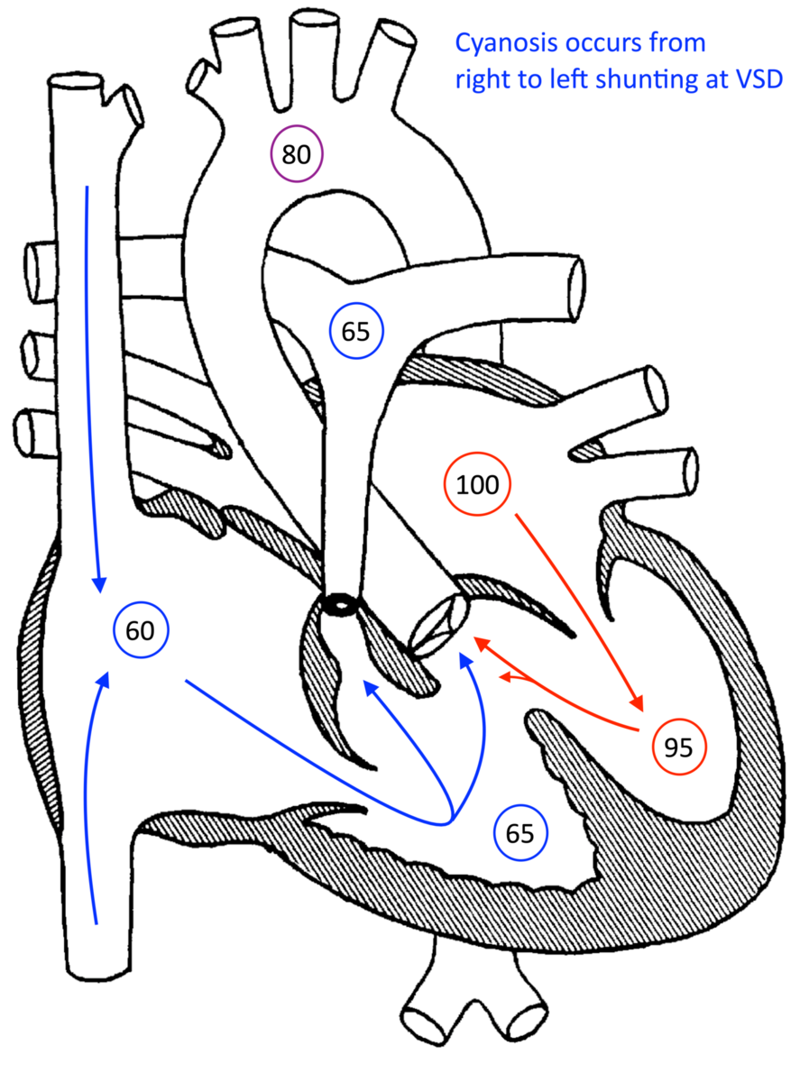Tetralogy of Fallot Pediatric Echocardiography (2022)